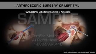 Arthroscopic Surgery of Left TMJ [upl. by Lemuelah575]