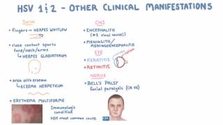 HSV  Clinical Presentation  Part 2 [upl. by Bigot]