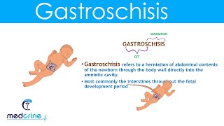 Gastroschisis Definition Causes and Diferences with Omphalocele [upl. by Dnana]