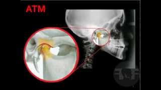 ATM Odontologia® Articulación Temporomandibular [upl. by Grindlay108]