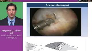 Gluteus Medius Tears Techniques and Indications [upl. by Delilah]