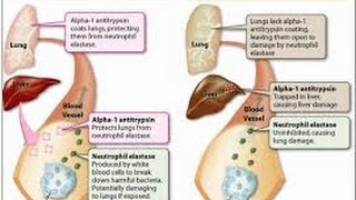 alpha 1 antitrypsin deficiency [upl. by Kostival]