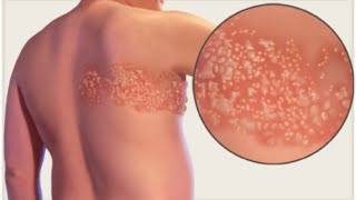 Herpes Zoster Shingles [upl. by Andeee]