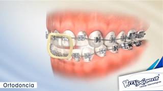 Corrección de mordida y espacios dentales quotOrtodonciaquot [upl. by Addiel]