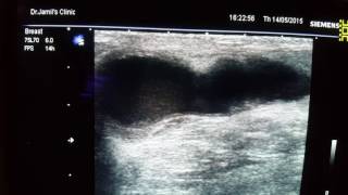 Galactocele Ultrasound [upl. by Mafala]