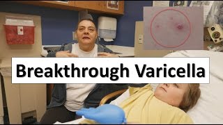 Breakthrough Varicella [upl. by Eelatan]