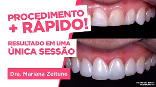 TRANSFORME SEU SORRISO Facetas e lentes de contato em resina composta Saiba tudo [upl. by Wildee]