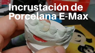 INCRUSTACIÓN Dental de Porcelana👅 EMax Onlay dentaltip [upl. by Nevai]