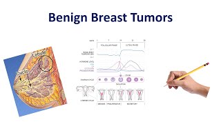 Benign Breast Conditions  USMLE COMLEX NCLEX [upl. by Inek]