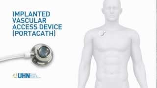 PortaCath Implanted Vascular Access Device [upl. by Oisacin]