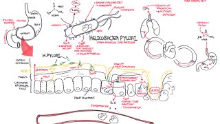 H Pylori Disease Diagnosis and Treatment [upl. by Yuht]