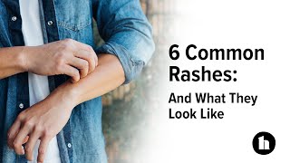 6 Common Rashes And What They Look Like  Healthline [upl. by Pressman]